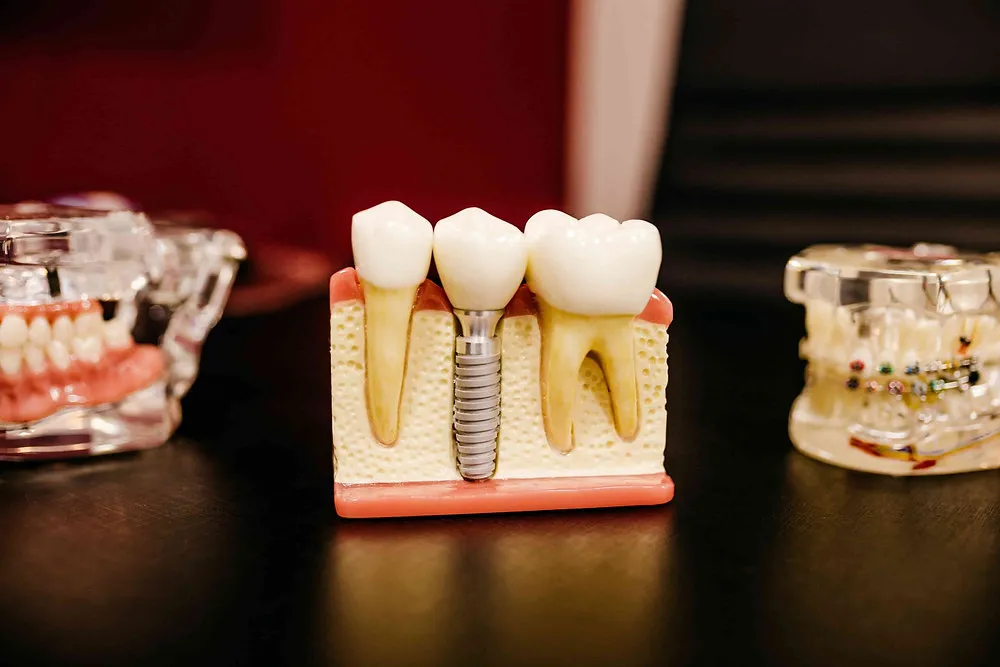 5 Reasons Why Dental Implants are the Ultimate Tooth Replacement Solution