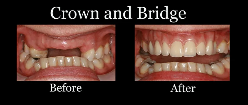 The Enigmatic Craftsmanship Behind Dental Bridges and Crowns