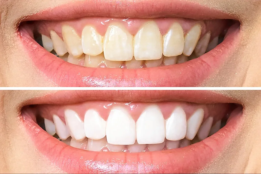 The Inside Scoop On Teeth Whitening