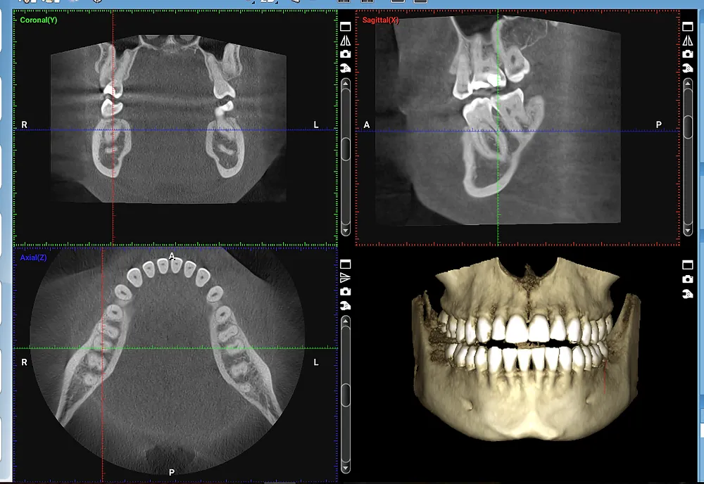 Revolutionizing Dental Implant Planning with CBCT Imaging
