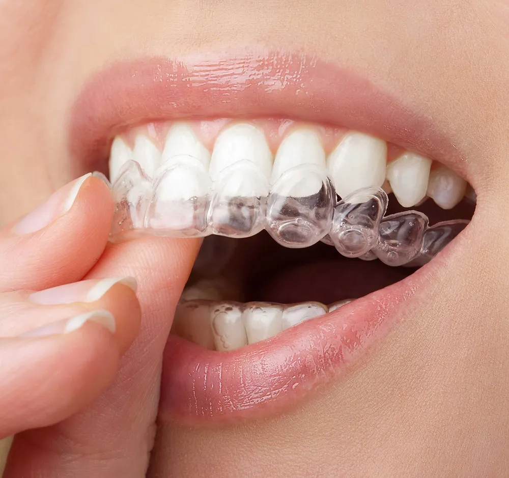 Get Ready for Invisalign Week — September 22–26!